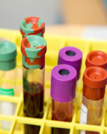 Mehrere Laborröhrchen mit farbigen Verschlüssen stehen in einem gelben Halter, einige enthalten Blutproben für medizinische Tests.