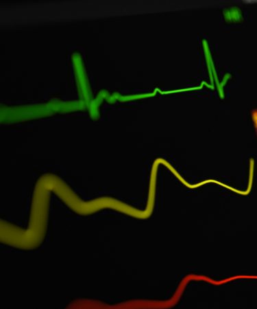 Ein dunkler Herzmonitor mit grüner EKG-Kurve und gelben Vitalwerten – Messung der Herzfrequenzvariabilität (HRV) im Sport.